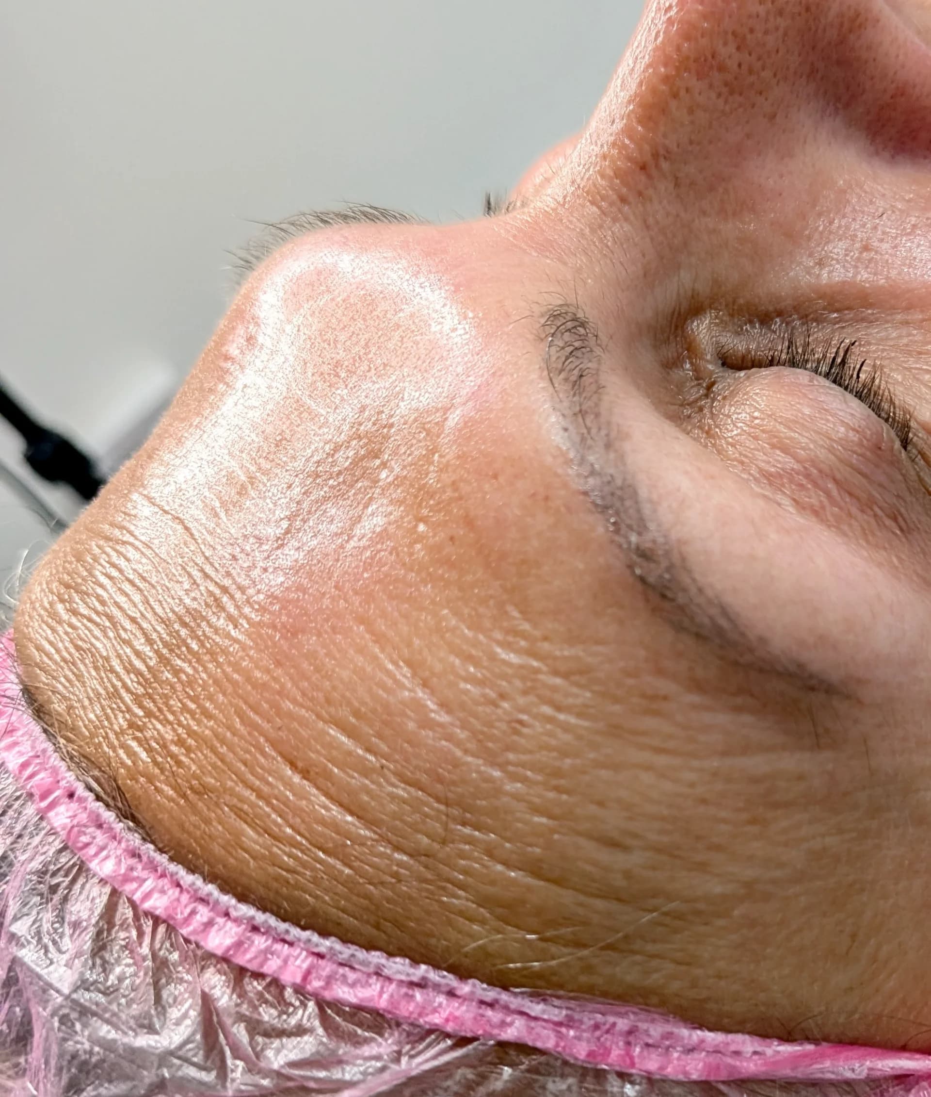 Biorepeel chemical peel